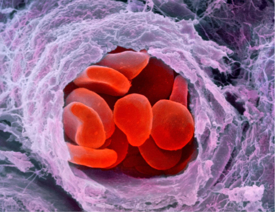 Hämophilie und Gentherapien